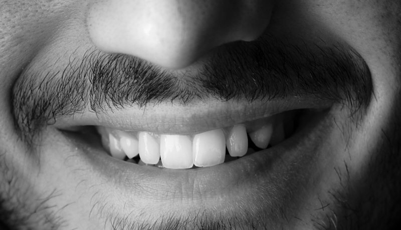 orthodontiste adulte embrun